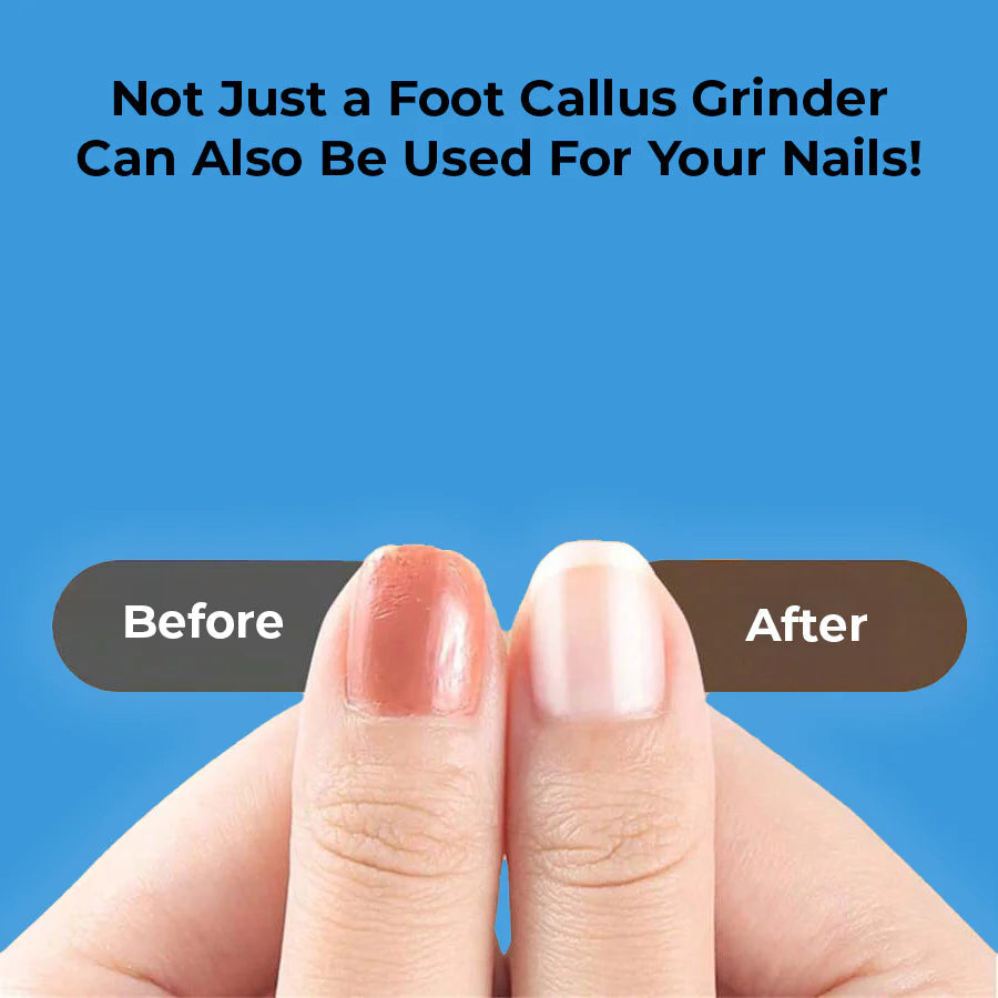 Electric Foot Callus Remover